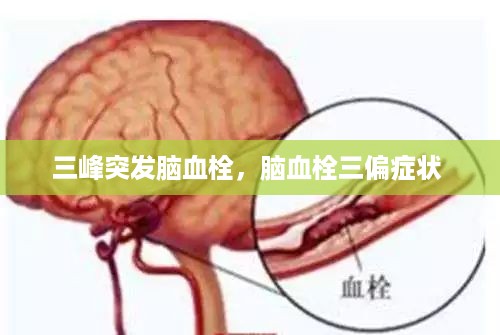 三峰突发脑血栓，脑血栓三偏症状 